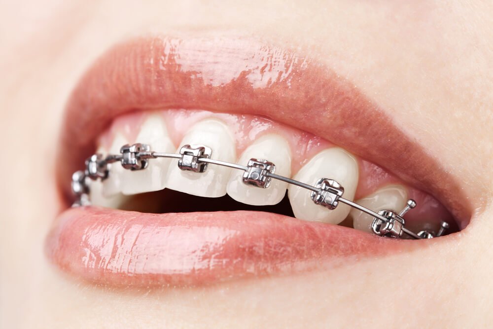 Are braces cosmetic dentistry?