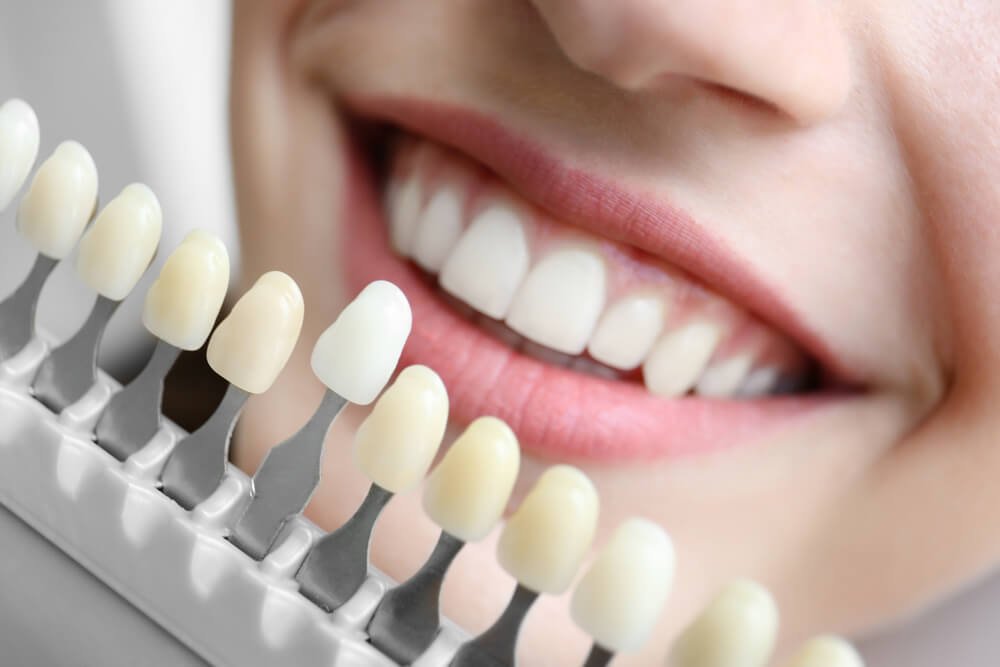 Is Bonding Your Teeth a Good Idea?